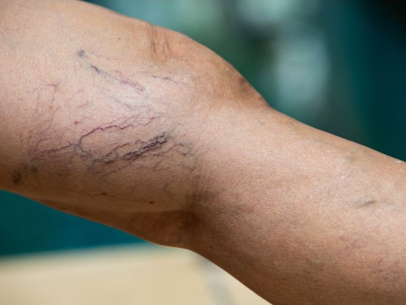 Beneficios do Laser em Tratamentos Vasculares em Belo Horizonte