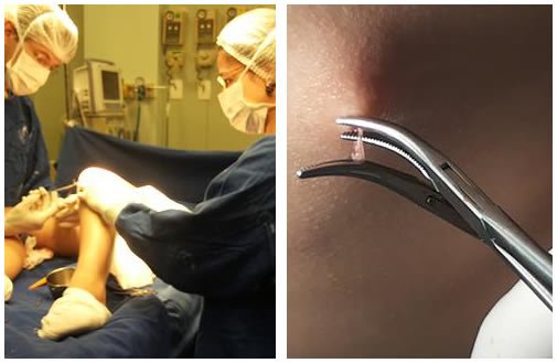 Cirurgia de Varizes Convencional e Endovascular em belo horizonte