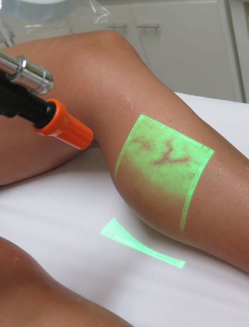 Escleroterapia em belo horizonte secagem de vazinhos