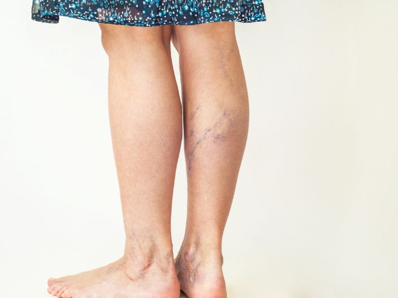 Ultimas Tecnicas em Cirurgia Vascular em Nova Lima