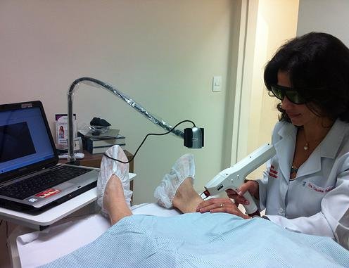 escleroterapia aplicacao de varizes tratamento varizes belo horizonte