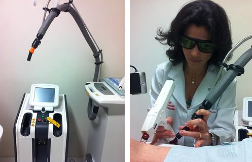 laser para tratamento de varizes em belo horizonte 1