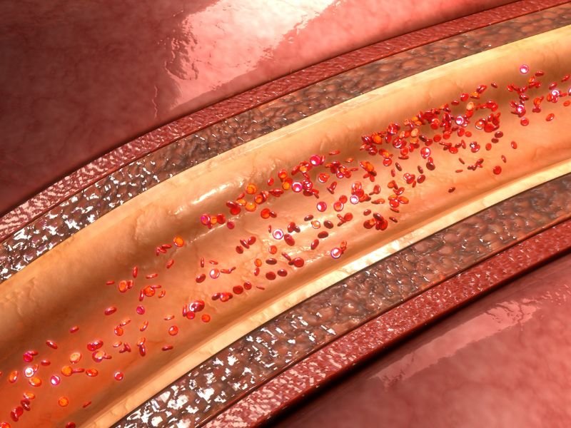 Como Desobstruir e Manter suas Arterias Limpas Naturalmente em Belo Horizonte