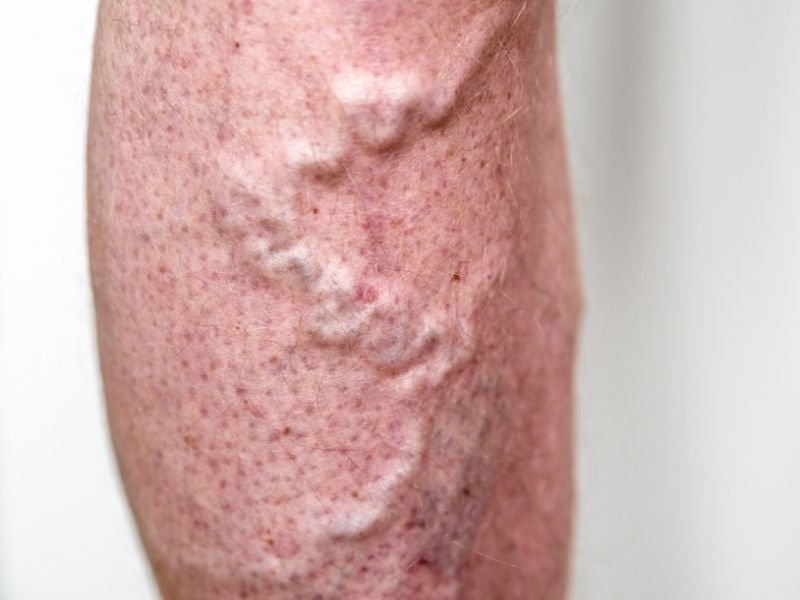 Como Tratar Vasinhos e Varizes em Belo Horizonte sem Cirurgia Tradicional