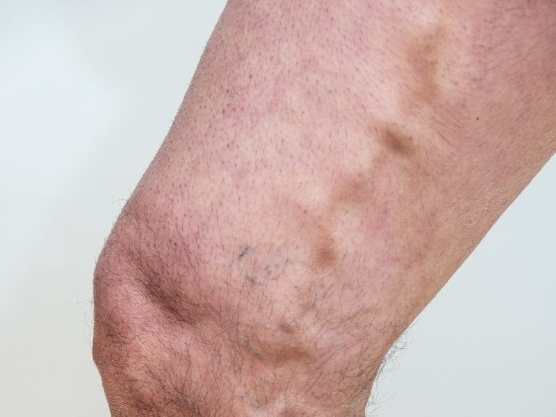 Escleroterapia para Varizes em Belo Horizonte Menos Dor e Mais Seguranca