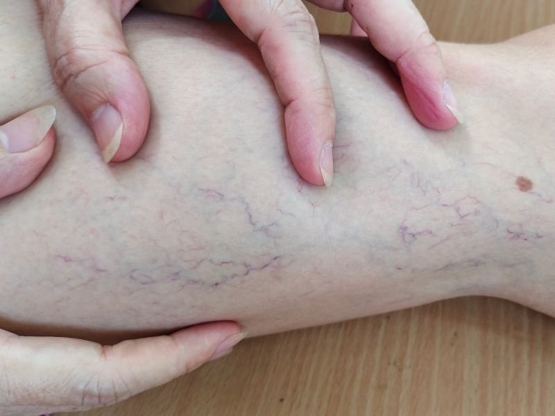 Laser para Varizes em Belo Horizonte Procedimento Moderno e Seguro