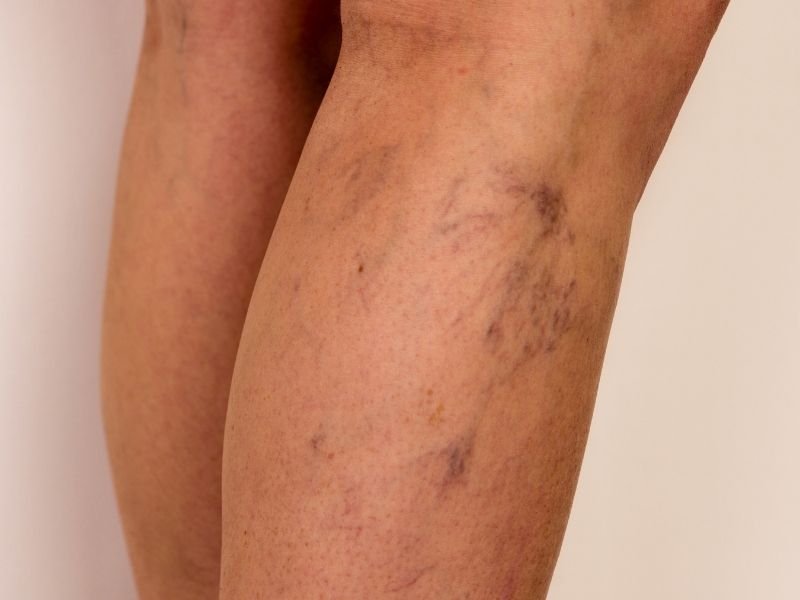 Medico Especialista em Varizes em Belo Horizonte Tratamento com Laser e Escleroterapia