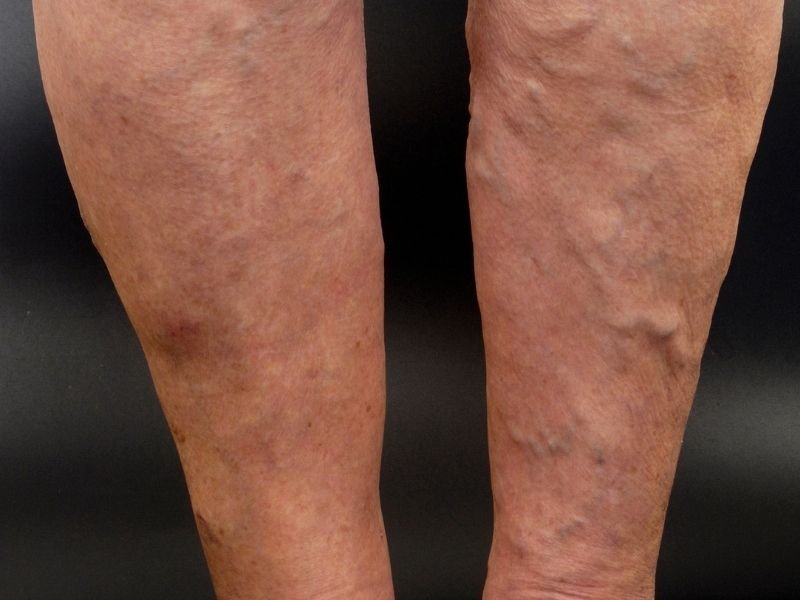 Tratamento de Varizes com Laser em Belo Horizonte Preserve sua Veia Safena