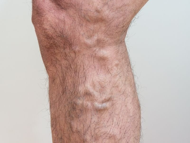 Tratamento de Vasinhos em Belo Horizonte com Laser NdYAG e Crioescleroterapia