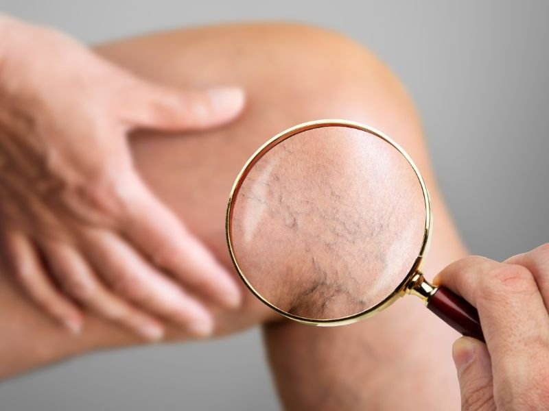 Tratamento para Refluxo Venoso Inicial em Belo Horizonte sem Cirurgia Invasiva